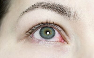 Prevención de la conjuntivitis: guía completa para proteger tus ojos