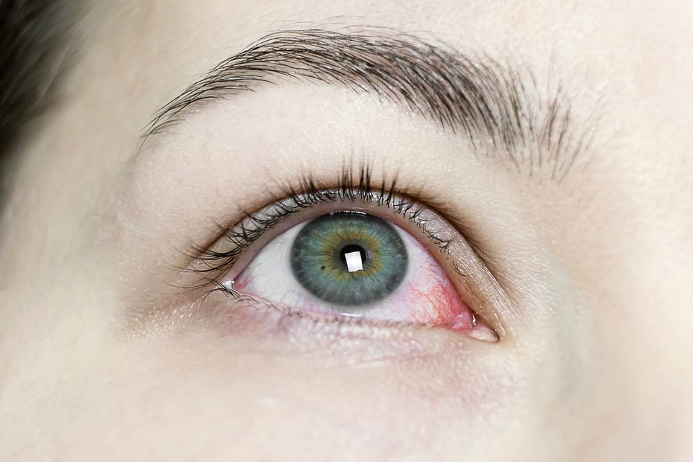 prevención de la conjuntivitis