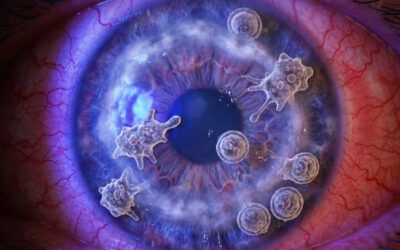 El peligro invisible del verano: cómo proteger tus ojos de la queratitis por Acanthamoeba